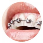 contenidos-tecnicas-ortodoncias-braquets