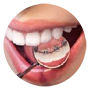 contenidos-tecnicas-ortodoncias-lingual