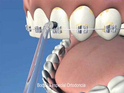 ortodoncia-irrigadores-bucales-2